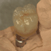 PFM over custom abutment