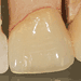 Porcelain Fused to Zirconium Framework