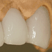 Diagnostic Wax Up